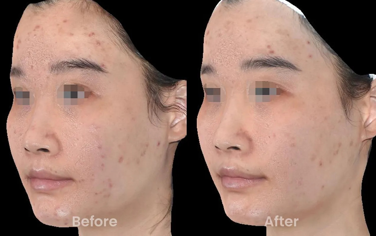 Kết quả lâm sàng sản phẩm 01 - Before và After