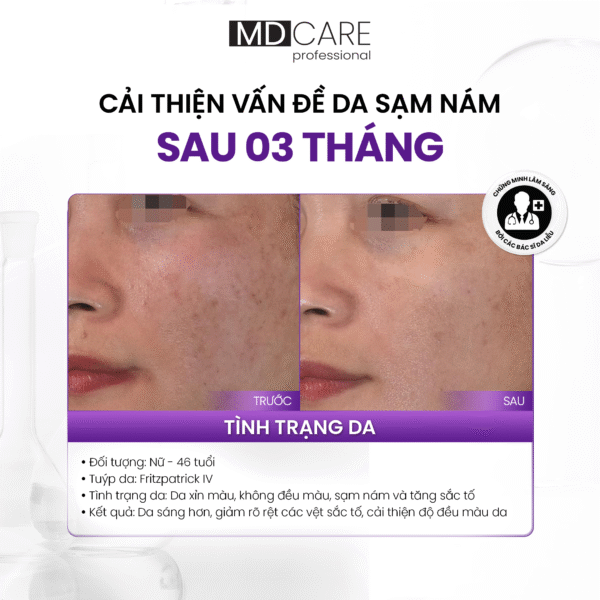 Ảnh case lâm sàng - cải thiện vấn đề da sạm nám sau 3 tháng